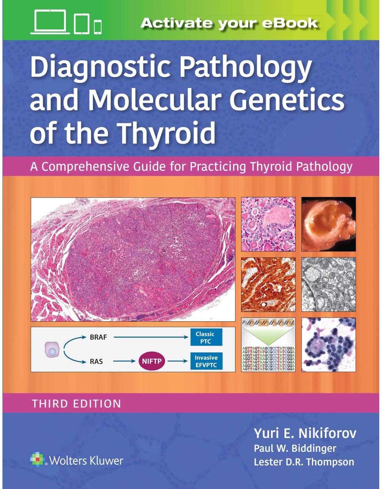 Diagnostic Pathology and Molecular Genetics of the Thyroid: A Comprehensive Guide for Practicing Thyroid Pathology