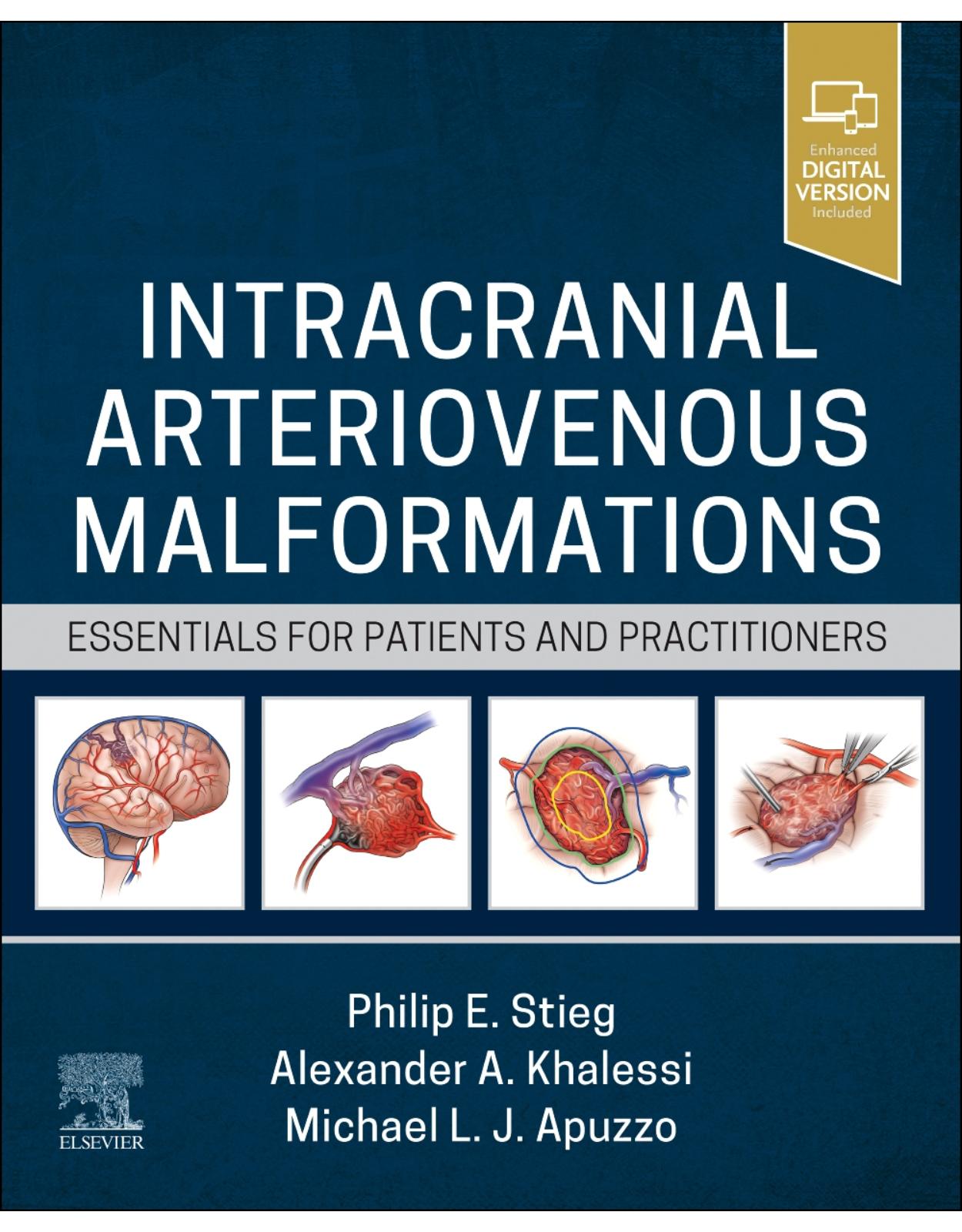 Intracranial Arteriovenous Malformations