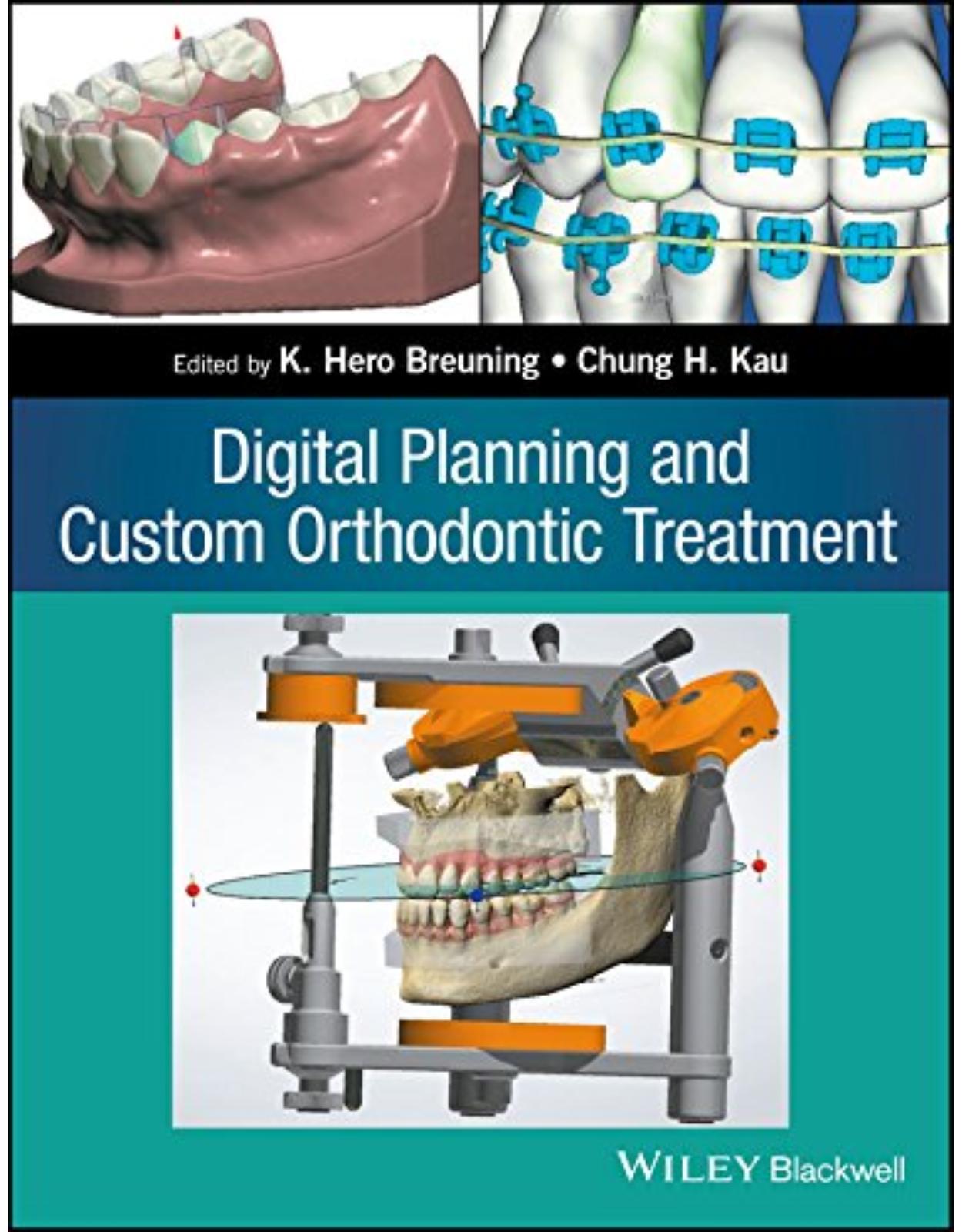 Digital Planning and Custom Orthodontic Treatment 