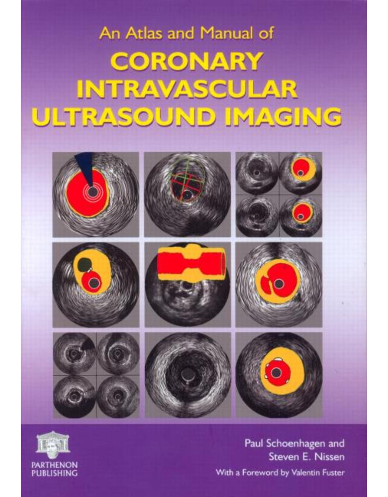 An Atlas and Manual of Coronary Intravascular Ultrasound Imaging