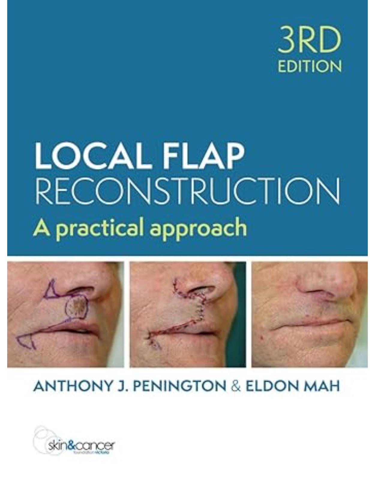 Local Flap Reconstruction, 3rd Edition