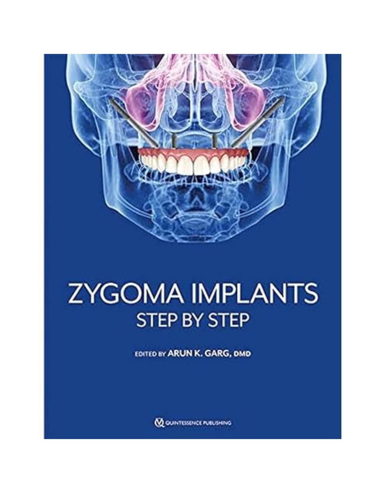 Zygoma Implants: Step by Step
