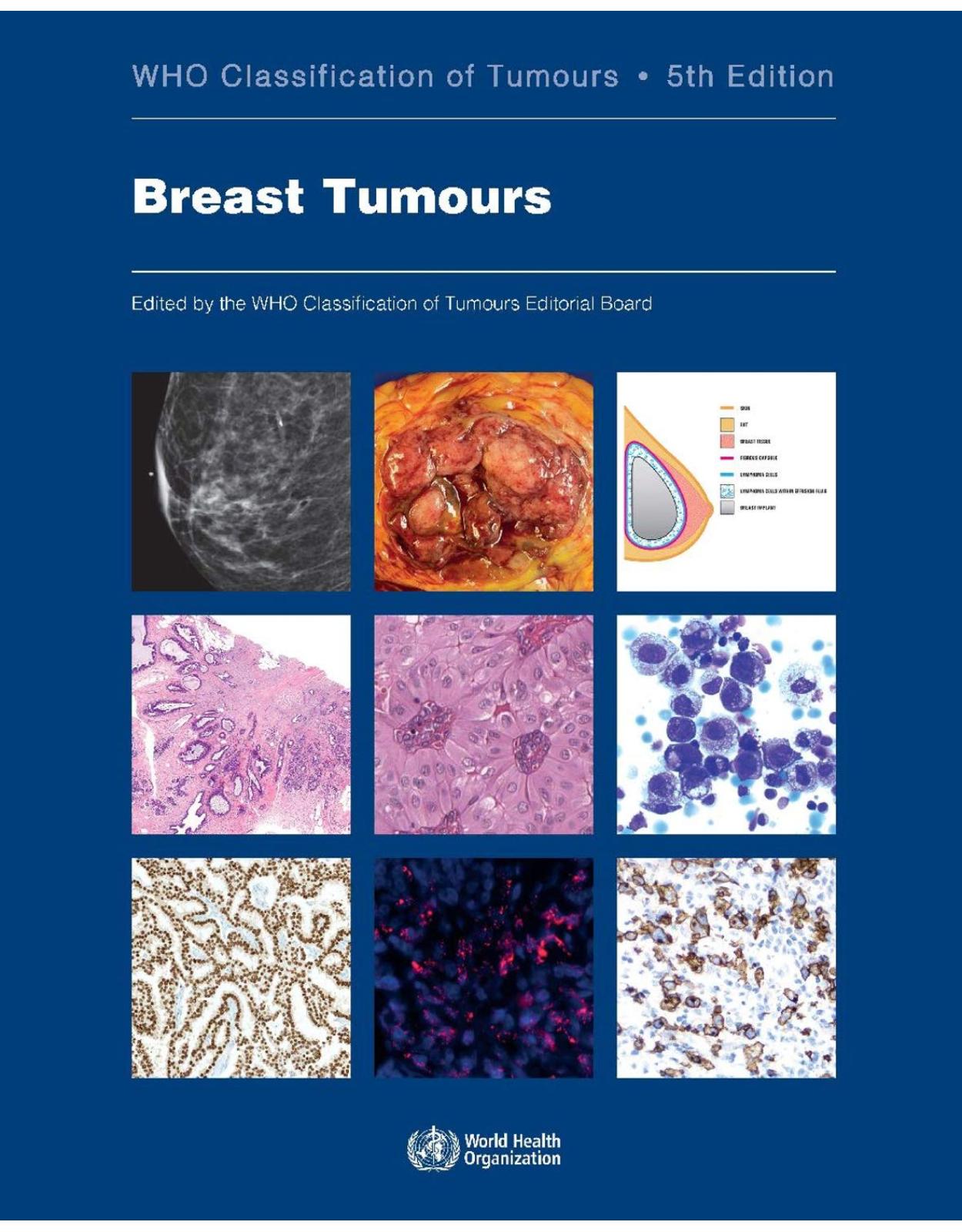 WHO classification of tumours of the breast: 2