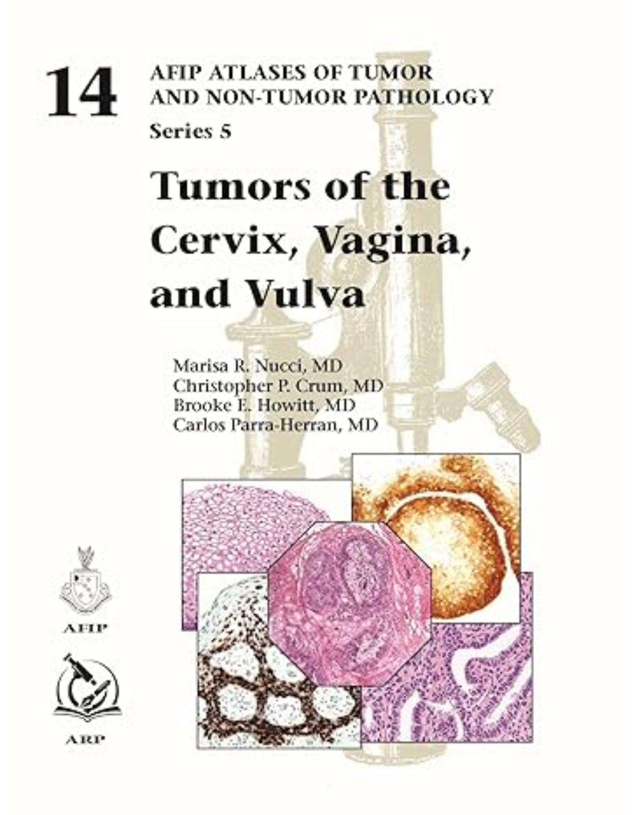 Tumors of the Cervix, Vagina, and Vulva