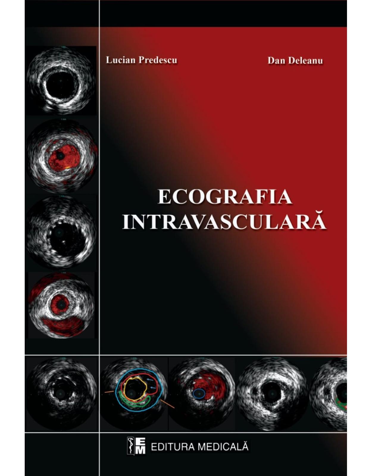Ecografie intravasculara
