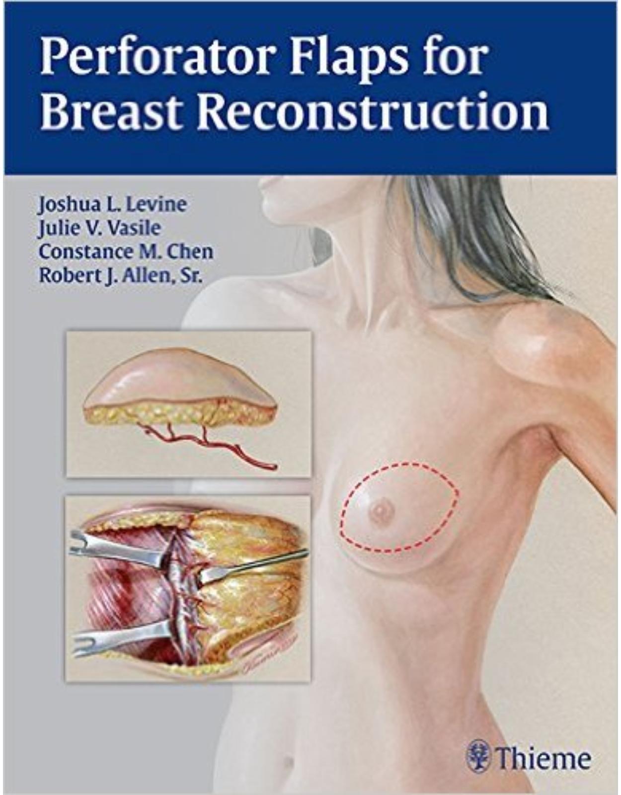 Perforator Flaps for Breast Reconstruction