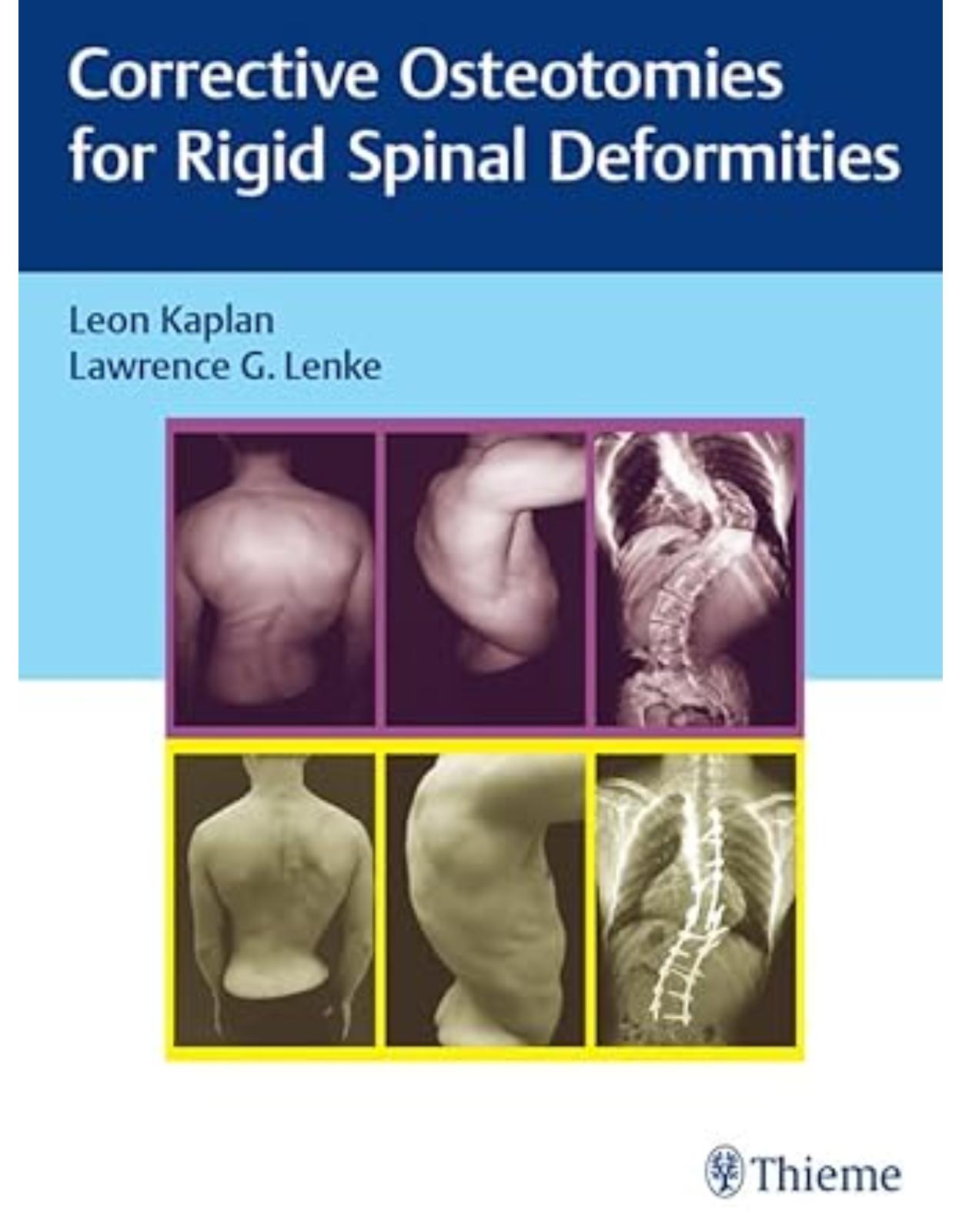 Corrective Osteotomies for Rigid Spinal Deformities