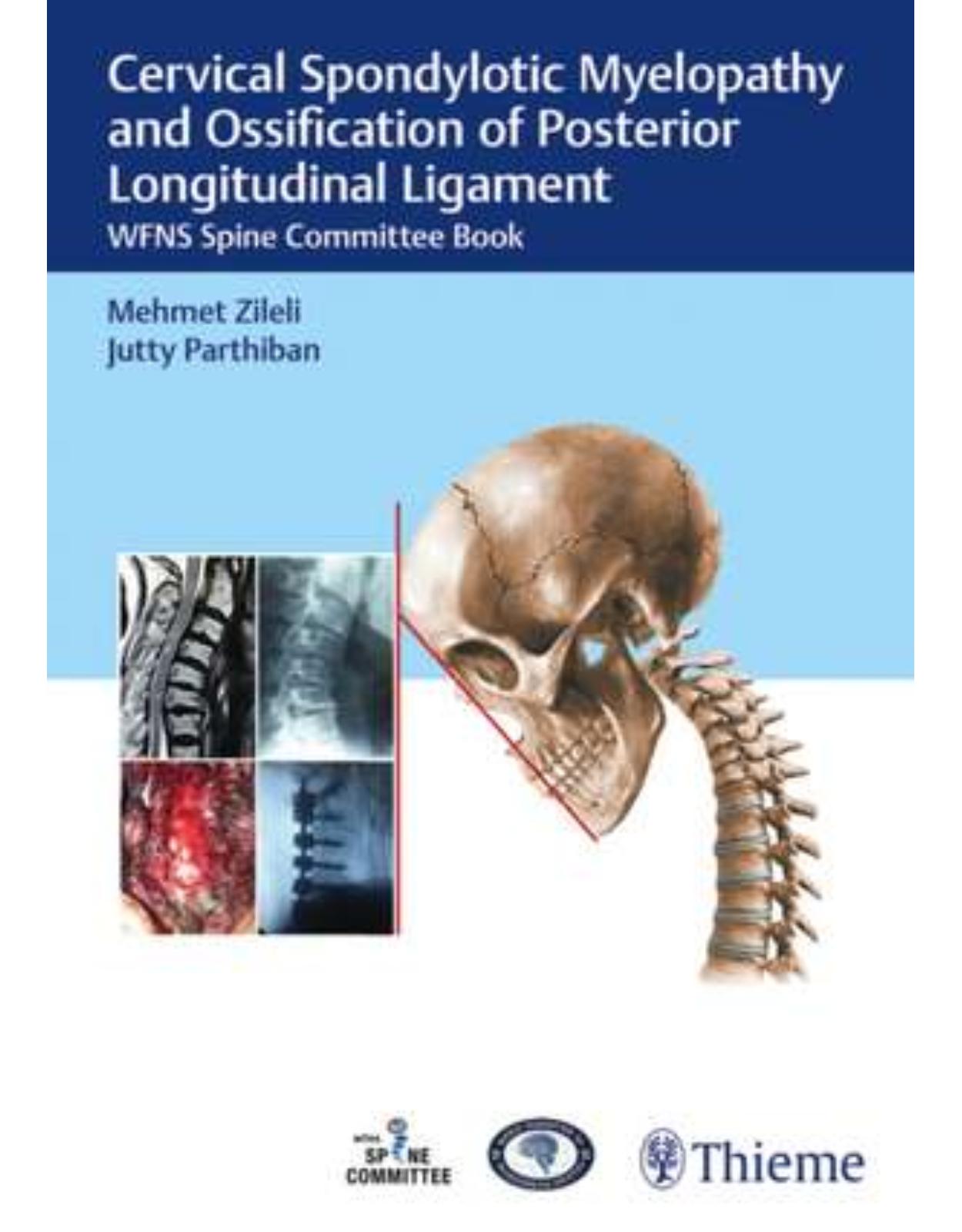 Cervical Spondylotic Myelopathy and Ossification