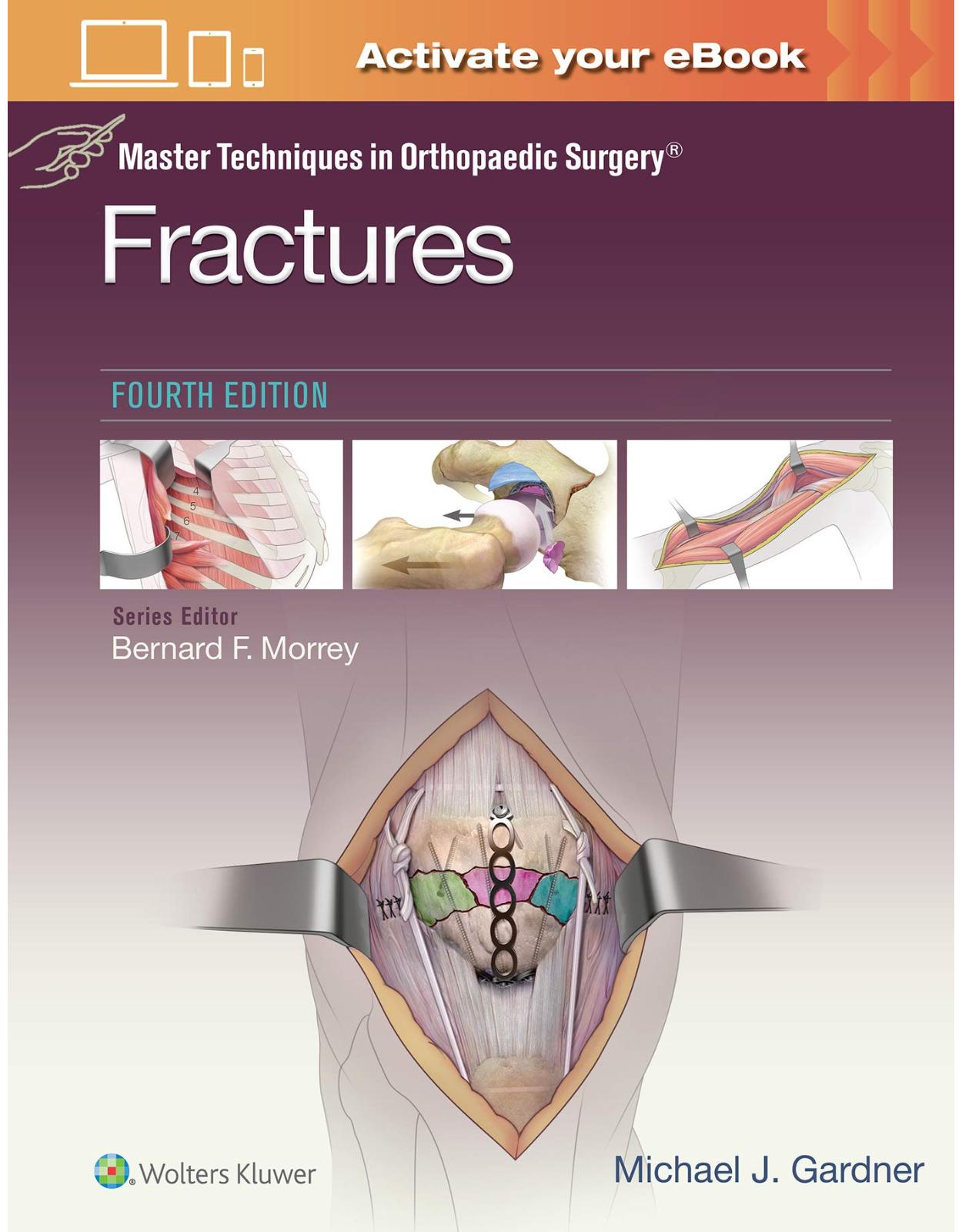 Master Techniques in Orthopaedic Surgery: Fractures