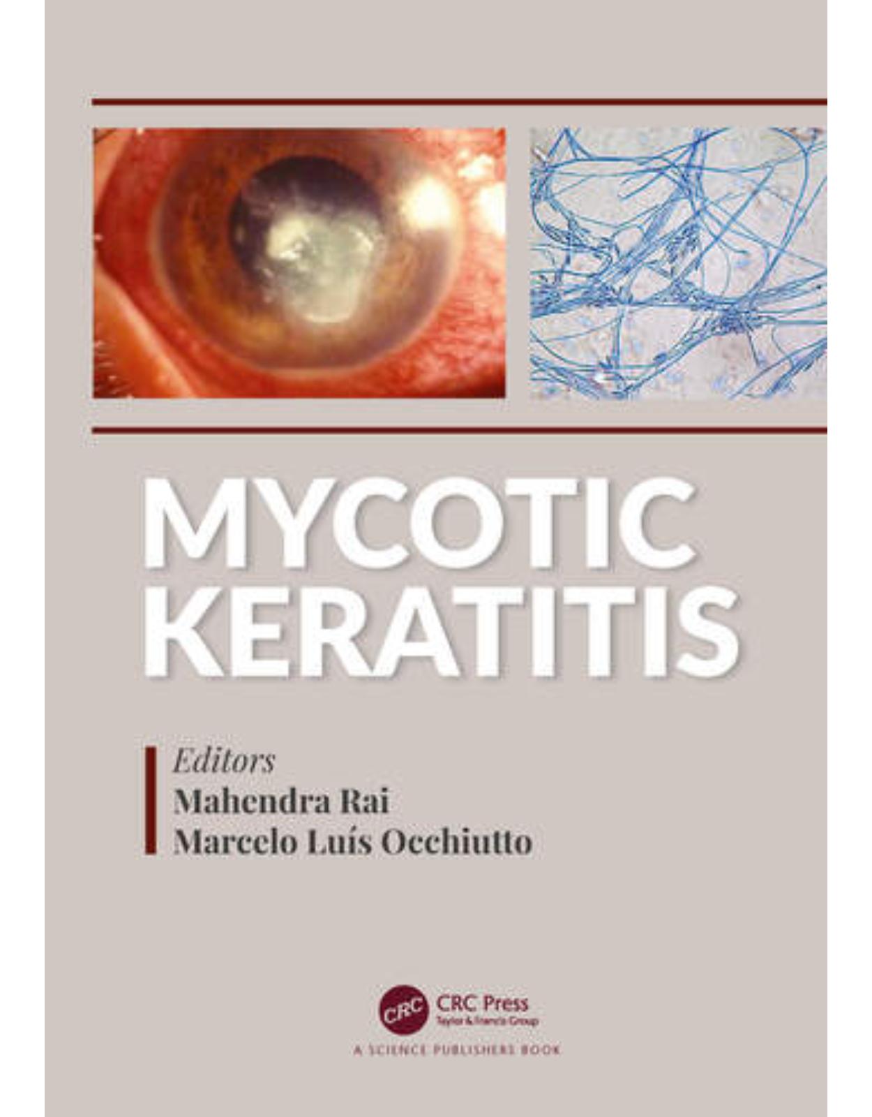 Mycotic Keratitis