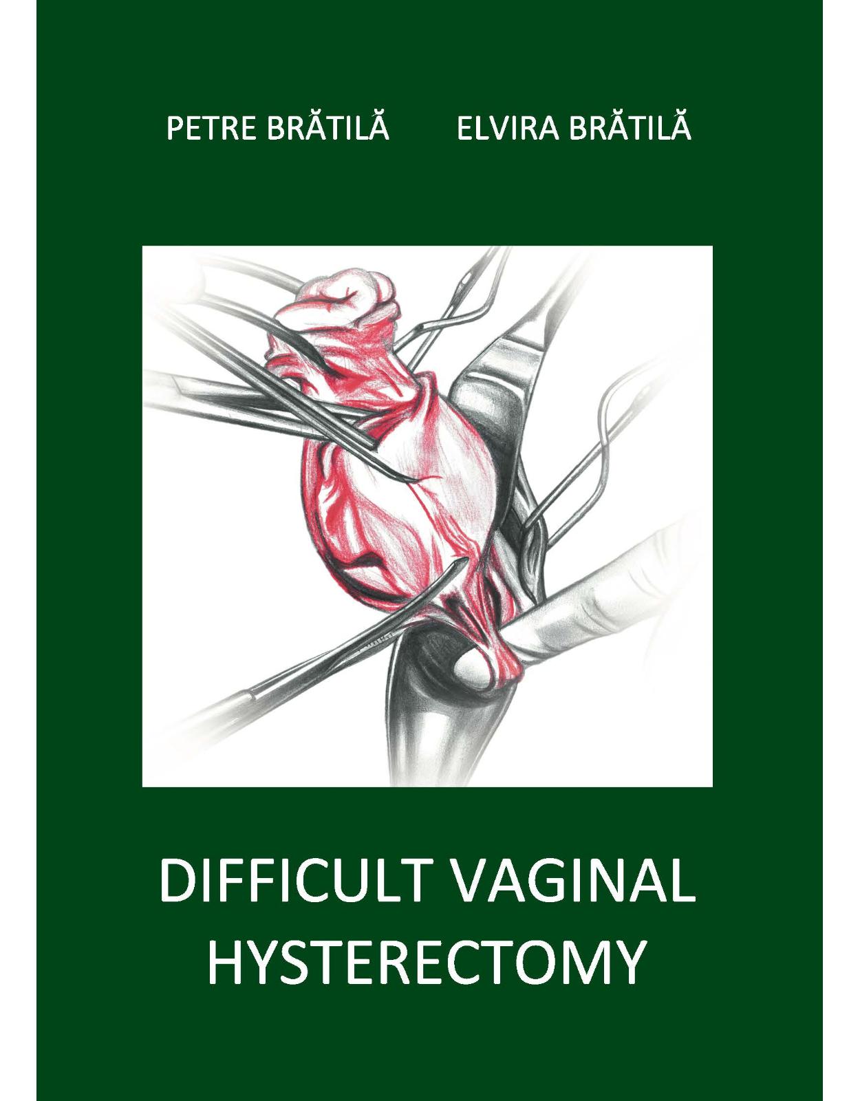 Difficult vaginal hysterectomy